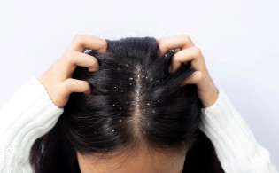 চুলে খুশকি হওয়ার কারণ ও প্রতিকার