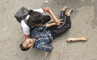 পুলিশের লাঠিচার্জে কৃত্রিম হাতও হারালেন জুলাই যোদ্ধা