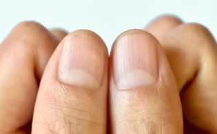 নখের গোড়ার সাদা অর্ধচাঁদ আপনার স্বাস্থ্যের সংকেত দিতে পারে