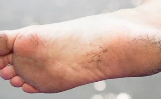 পা ফাটার কারণ হতে পারে যে ৪ রোগ