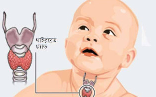 যেসব কারণে থাইরয়েড রোগে ভোগে শিশু