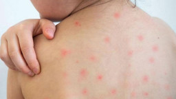 ১৯ দিনে হামের উপসর্গ নিয়ে প্রাণ হারাল ৯৪ শিশু