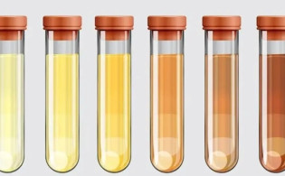 প্রস্রাব দেখেই বোঝা সম্ভব ৫টি বড় রোগ