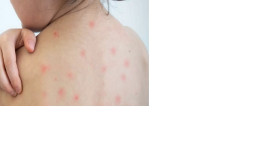 জ্বর থেকে অন্ধত্ব— জানুন হামের মারাত্মক প্রভাব