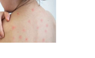 জ্বর থেকে অন্ধত্ব— জানুন হামের মারাত্মক প্রভাব