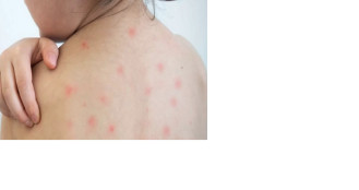 জ্বর থেকে অন্ধত্ব— জানুন হামের মারাত্মক প্রভাব