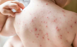 চিকেনপক্স নাকি হাম—চিনবেন যেভাবে